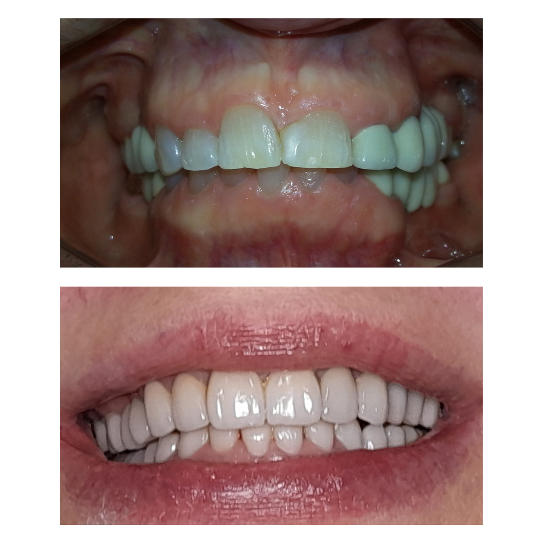 Rehabilitacion completa con coronas en zirconia sobre piezas naturales y sobre implantes.