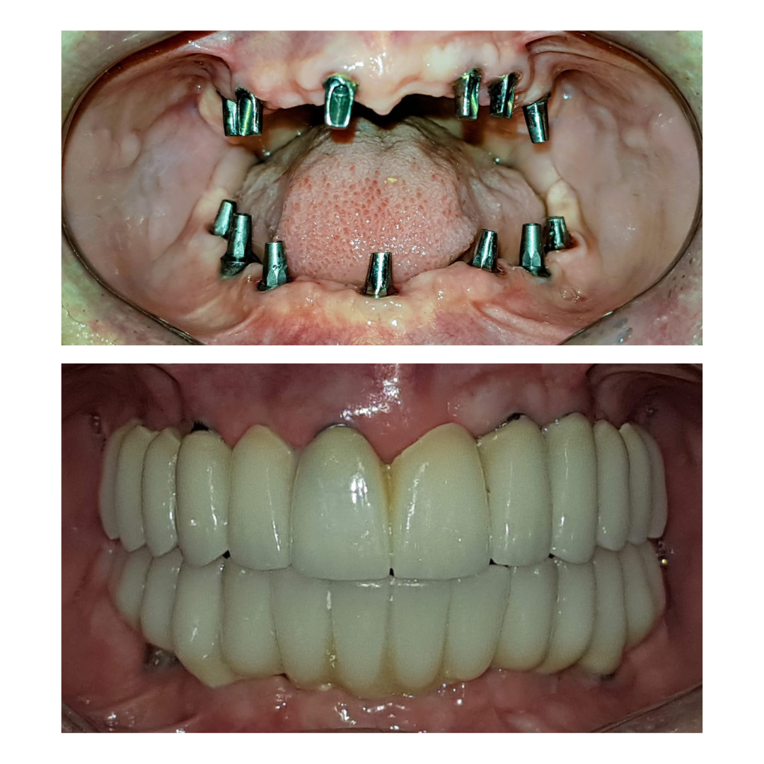 edentulo de coronas sobre implantes